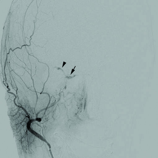 Cerebral angiography