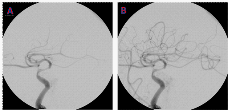 Cerebral angiography