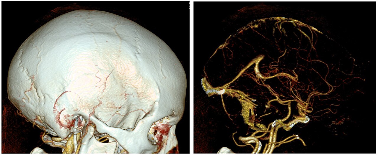 Cerebral angiography