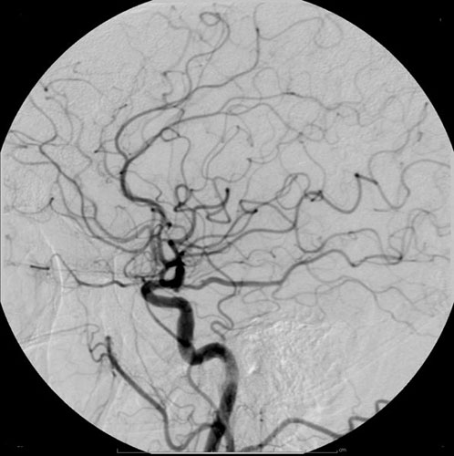 Cerebral angiography