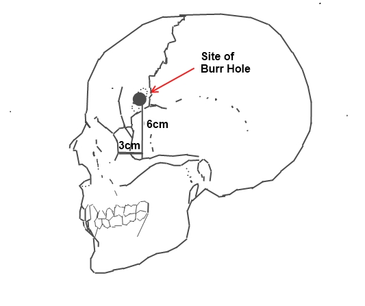 Lobotomy
